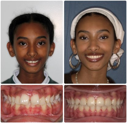 Braces 2026 - A couple of cases this past year. From early age orthodontics to teen/adult orthodontics, Mashouf Orthodontics has options for everyone. Braces 2026 - A couple of cases this past year. From early age orthodontics to teen/adult orthodontics, Mashouf Orthodontics has options for everyone.