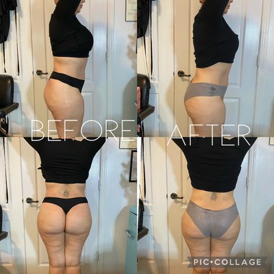 Body Sculpting - Body sculpting is a great way to get rid of stubborn fat and to reduce cellulite. Body Sculpting - Body sculpting is a great way to get rid of stubborn fat and to reduce cellulite.