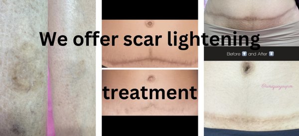 Scar Lightening Treatments - We offer scar lightning treatments Scar Lightening Treatments - We offer scar lightning treatments