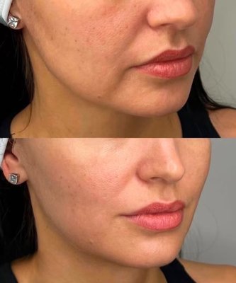 Perioral Anti-Aging - Perioral anti-aging treatments focus on reducing fine lines and wrinkles around the mouth to restore a youthful appearance. Perioral Anti-Aging - Perioral anti-aging treatments focus on reducing fine lines and wrinkles around the mouth to restore a youthful appearance.