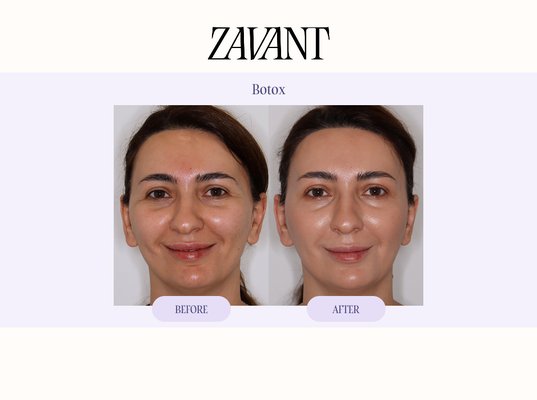 Botox - Explore Botox treatments at Zavant Aesthetics. Botox is a neuromodulator used to soften the appearance of expression lines and wrinkles while maintaining natural-looking facial movement. Treatment is personalized to each patient’s facial anatomy, features, and aesthetic goals for balanced, refined results.
Browse our Botox before-and-after results to see examples of treatments performed at Zavant Aesthetics. Botox - Explore Botox treatments at Zavant Aesthetics. Botox is a neuromodulator used to soften the appearance of expression lines and wrinkles while maintaining natural-looking facial movement. Treatment is personalized to each patient’s facial anatomy, features, and aesthetic goals for balanced, refined results.
Browse our Botox before-and-after results to see examples of treatments performed at Zavant Aesthetics.