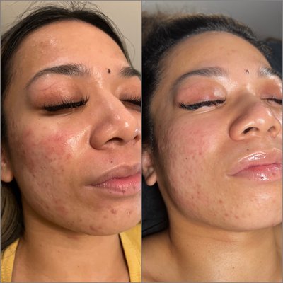 Acne Facial - The Relief Facial is a 60 minute customized Acne facial including,

Skin Analysis, Double Cleanse with Steam, Exfoliant, Emphasis on Extraction, High Frequency to help kill bacteria on the skin, Custom Acne Face Mask with LED Blue Light Therapy and Customized Product Layering geared towards relieving your skin of inflammation.

ADD ON OPTIONS:

Aura Cleansing - $10
Hydrojelly Mask - $20