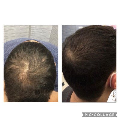 Platelet Rich Plasma (PRP) For Hair Loss Treatment - Platelet-rich plasma (PRP) is a treatment that doctors use to accelerate healing in various areas of the body. It may help restore hair growth. Platelet Rich Plasma (PRP) For Hair Loss Treatment - Platelet-rich plasma (PRP) is a treatment that doctors use to accelerate healing in various areas of the body. It may help restore hair growth.