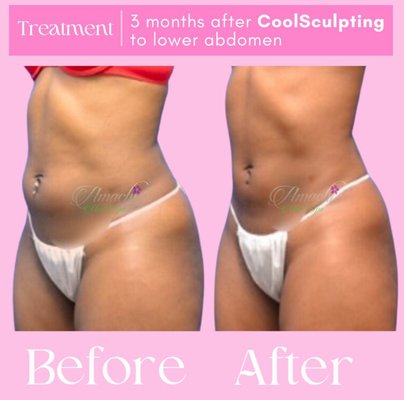 Non-Surgivcal Fat Reduction (CoolSculpting) - Transform your body, transform your confidence with our non-surgical fat removal using Coolsculpting. We are certified! Our award winning medspa is guided by a double board certified Plastic Surgeon with many years of experience. Non-Surgivcal Fat Reduction (CoolSculpting) - Transform your body, transform your confidence with our non-surgical fat removal using Coolsculpting. We are certified! Our award winning medspa is guided by a double board certified Plastic Surgeon with many years of experience.