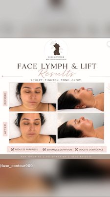 Face lymph and lift results - Face Lymph & Lift is a relaxing, non-invasive treatment that combines manual lymphatic drainage with radio frequency to reduce puffiness, define the jawline, improve circulation, and tighten the skin. Perfect for a naturally refreshed, lifted appearance with no downtime. Face lymph and lift results - Face Lymph & Lift is a relaxing, non-invasive treatment that combines manual lymphatic drainage with radio frequency to reduce puffiness, define the jawline, improve circulation, and tighten the skin. Perfect for a naturally refreshed, lifted appearance with no downtime.