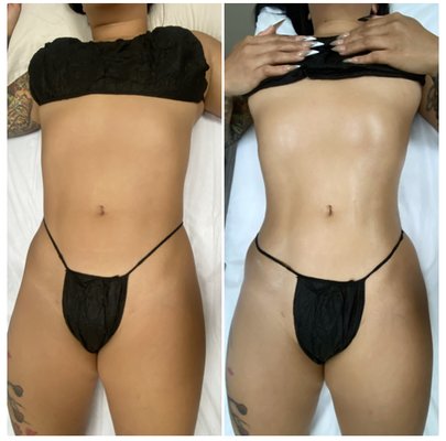 Brazilian Lymphatic Drainage (1 session) - Waist goals for this beauty. Results from one session of Brazilian Lymphatic Drainage. Brazilian Lymphatic Drainage (1 session) - Waist goals for this beauty. Results from one session of Brazilian Lymphatic Drainage.