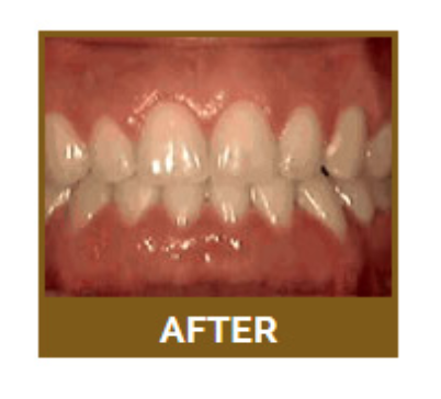 Spacing of the teeth - What is it? Wide spaces between the teeth are often caused either by unusually small teeth or by missing teeth. In some cases, the gaps might be symmetrical and regular; in others, there might only be a single gap, such as between the front two teeth.

How is it treated? If a client chooses to have their gaps closed, the options will depend on the situation. If there are small gaps, one of the simplest treatments could be veneers. Veneers bond to the teeth and allow dentists to change their apparent size, shape, and spacing. If more extensive realignment is needed, braces could be an option.
