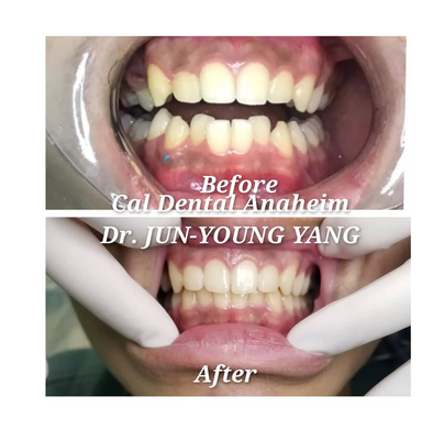 Invisalign special! - Invisalign starts from $3,000.00
CALL AND ASK FOR MORE DETAILS!
We are open Sunday!
Cal Dental Anaheim
3006 W LINCOLN AVE
ANAHEIM, CA 92801
(714) 828 0508
#implantandcosmeticdentistry
#newesttechnology #Vatechsmartct
#itero5dscanner #CALDENTALANAHEIM Invisalign special! - Invisalign starts from $3,000.00
CALL AND ASK FOR MORE DETAILS!
We are open Sunday!
Cal Dental Anaheim
3006 W LINCOLN AVE
ANAHEIM, CA 92801
(714) 828 0508
#implantandcosmeticdentistry
#newesttechnology #Vatechsmartct
#itero5dscanner #CALDENTALANAHEIM