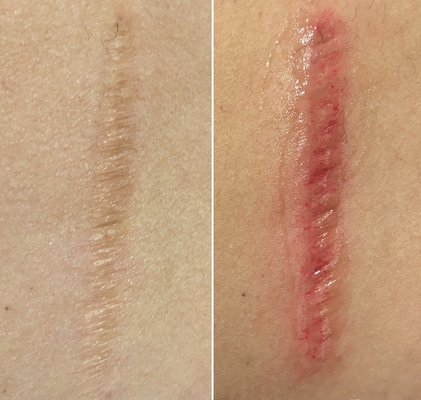 Inkless Scar Revision - This is immediately before and after an inkless scar revision.