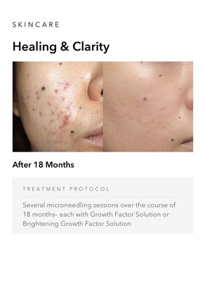 Microneedling Before and After - Microneedling Before and After Microneedling Before and After - Microneedling Before and After