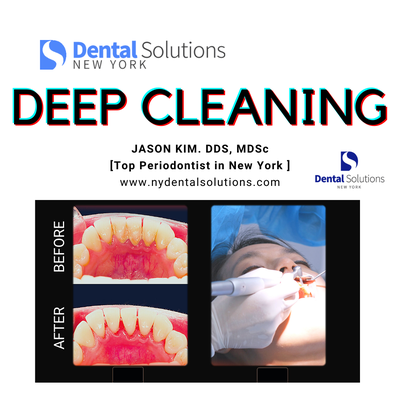 Dental Deep Cleaning Scaling & Root Planing - If you suffer from chronic gum disease, your dentist may recommend dental Scaling to thoroughly remove the tartar and bacteria from both the surfaces of your teeth and beneath your gums. Dental scaling is a deep cleaning of both your exposed tooth surfaces and the pockets below your gum line, reaching deeper into your gums than through regular dental cleaning. In Teeth Scaling, your dentist will thoroughly remove the buildup of plaque, tartar, and bacteria causing the inflammation of your gums. Dental scaling will allow your gums to once again form an effective seal for the roots of your teeth against the outside environment. Dental Deep Cleaning Scaling & Root Planing - If you suffer from chronic gum disease, your dentist may recommend dental Scaling to thoroughly remove the tartar and bacteria from both the surfaces of your teeth and beneath your gums. Dental scaling is a deep cleaning of both your exposed tooth surfaces and the pockets below your gum line, reaching deeper into your gums than through regular dental cleaning. In Teeth Scaling, your dentist will thoroughly remove the buildup of plaque, tartar, and bacteria causing the inflammation of your gums. Dental scaling will allow your gums to once again form an effective seal for the roots of your teeth against the outside environment.