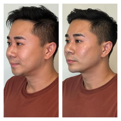 Jawline Filler - Our patients beautiful results after injecting Xeomin and Raddiesse to contour jawline and cheek bones. Jawline Filler - Our patients beautiful results after injecting Xeomin and Raddiesse to contour jawline and cheek bones.