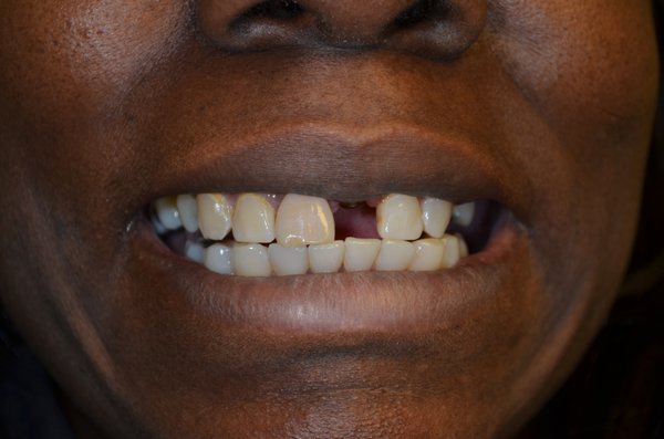 Front tooth Implant. - This patient was missing a front tooth for several years. We handled this case with a perfect match on the crown after a visit to the lab for custom shading. Front tooth Implant. - This patient was missing a front tooth for several years. We handled this case with a perfect match on the crown after a visit to the lab for custom shading.