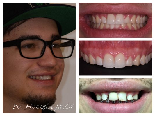 Multi Stage Smile Transformation - This young man found us online and came for a consultation. He like many patients would benefit from a multidisciplinary and multi stage treatment. Patient suffered from sever flaring of teeth which requires Braces to correct. He also had a condition called alter passive eruption which required a Gum lift procedure. After going through Braces, a Gum Lift and a Temporary phase to establish the correct parameters for his smile. Once patient was ready to proceed with his cosmetic work we did our consultation and recommended 2 Signature Crowns and 4 Veneers to improve the shape of his teeth and cove his Smile. Patient decided to only do 2 Signature Crowns on the front 2 teeth and for go the recommended 4 Signature Veneers and 2 Crowns.
He now feels like a whole new person and only wishes He had done it sooner. This is a signature case done by world-renowned master technicians. We do life-changing smile makeovers utilizing the latest minimally invasive treatment options and the latest technology. We take a team approach to making these life-changing smile transformations. We utilize the expertise of dental professionals specialized in all realms of dentistry to achieve the near-ideal results. He is extremely happy with the outcome and we are extremely happy to be able to give him a new smile.
-
We are passionate about caring for our patients. If you require dental care you can contact us to schedule your appointment. #Toothopia Multi Stage Smile Transformation - This young man found us online and came for a consultation. He like many patients would benefit from a multidisciplinary and multi stage treatment. Patient suffered from sever flaring of teeth which requires Braces to correct. He also had a condition called alter passive eruption which required a Gum lift procedure. After going through Braces, a Gum Lift and a Temporary phase to establish the correct parameters for his smile. Once patient was ready to proceed with his cosmetic work we did our consultation and recommended 2 Signature Crowns and 4 Veneers to improve the shape of his teeth and cove his Smile. Patient decided to only do 2 Signature Crowns on the front 2 teeth and for go the recommended 4 Signature Veneers and 2 Crowns.
He now feels like a whole new person and only wishes He had done it sooner. This is a signature case done by world-renowned master technicians. We do life-changing smile makeovers utilizing the latest minimally invasive treatment options and the latest technology. We take a team approach to making these life-changing smile transformations. We utilize the expertise of dental professionals specialized in all realms of dentistry to achieve the near-ideal results. He is extremely happy with the outcome and we are extremely happy to be able to give him a new smile.
-
We are passionate about caring for our patients. If you require dental care you can contact us to schedule your appointment. #Toothopia