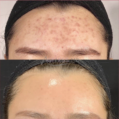 Acne Treatments - At AgelessMD we offer a comprehensive menu of treatments for those who are struggling with active acne, acne scars, or skin related concerns. From lasers, to fillers, to facials, or chemical peels, we offer everything under the sun to help you feel like you again!
Regain your confidence with AgelessMD and contact us today to book your consultation with our expert providers. Acne Treatments - At AgelessMD we offer a comprehensive menu of treatments for those who are struggling with active acne, acne scars, or skin related concerns. From lasers, to fillers, to facials, or chemical peels, we offer everything under the sun to help you feel like you again!
Regain your confidence with AgelessMD and contact us today to book your consultation with our expert providers.