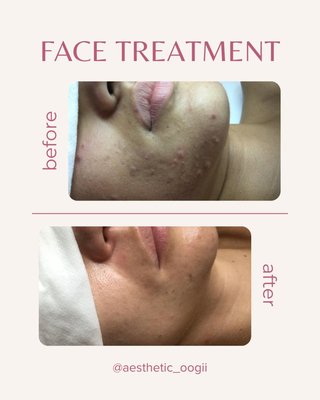 Acne clearing - Transformation time! Check out my journey from acne to clear skin! With the right treatments and consistency, anything is possible. Say goodbye to breakouts and hello to confidence!#AcneFree #SkincareJourney #BeforeAndAfter"