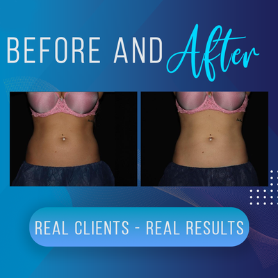 Flanks - Before and After Photos - CoolSculpting - Before and After photos for CoolSculpting on Flanks. See our amazing client results!