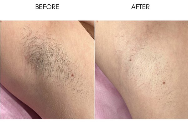 Underarm Laser Hair Removal - One of our most popular treatments. Underarm laser hair removal is quick, comfortable, and helps reduce shaving, irritation, and ingrown hairs while providing long-term hair reduction.