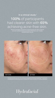 Hydrafacial 2025 - Aesthetic OOGII skincare clinic specializes in providing effective treatments for stubborn acne, ensuring clear and healthy skin for all clients.