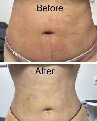 Before and After - In only 2 Manual Lymphatic Drainage sessions, this client's swelling went down drastically and it helped with her pain and bruising.