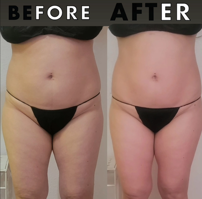 Body Cavitation and Butt Enhancement - Body Cavitation is a scientifically supported method for reducing inches, with noticeable results after just one session, all without the need for surgery. Moreover, we provide non-surgical butt enhancement to help you attain your desired shape effortlessly. Body Cavitation and Butt Enhancement - Body Cavitation is a scientifically supported method for reducing inches, with noticeable results after just one session, all without the need for surgery. Moreover, we provide non-surgical butt enhancement to help you attain your desired shape effortlessly.