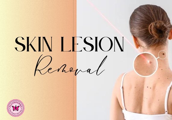 Skin Lesion Removal - Skin lesion removal is a quick and painless procedure with minimal downtime. This procedure utilizes laser technology to gently shave the lesion away (layer by layer) from the surface of the skin. Patients can return to work straight away. After the consultation, we offer same-day treatment (if desired). Pricing can vary depending on numerous factors such as how many lesions require removal, their location, and their size.