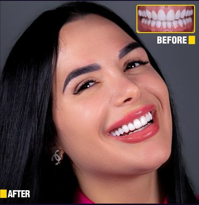 Smile Design 20 Teeth | Translucent Porcelain Veneers - Visit https://www.wholedentaldesign.com/ 20 Teeth Smile Design | Porcelain Smile Design Veneers: Finance Available with No interest up to 24mo. Get your Hollywood Smile NOW and pay letter. 20 years of experience. Affordable Dental Care. Finance Available. Enjoy this $129/Month special (50% Off Yelp Customers Deal) limited time. Boost your self-confidence with a new beautiful computerized perfect smile. Unbeatable Broward, Miami & Palm Beach Deal. Smile Design 20 Teeth | Translucent Porcelain Veneers - Visit https://www.wholedentaldesign.com/ 20 Teeth Smile Design | Porcelain Smile Design Veneers: Finance Available with No interest up to 24mo. Get your Hollywood Smile NOW and pay letter. 20 years of experience. Affordable Dental Care. Finance Available. Enjoy this $129/Month special (50% Off Yelp Customers Deal) limited time. Boost your self-confidence with a new beautiful computerized perfect smile. Unbeatable Broward, Miami & Palm Beach Deal.