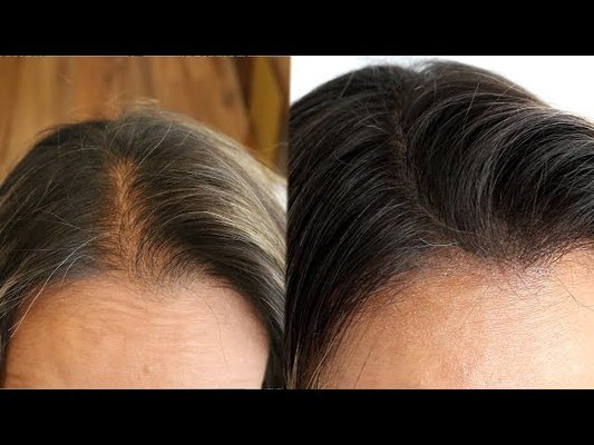 SMP Density Effect for Women – Grizzly Technique - At Grizzly Scalp, we recently treated a female client dealing with noticeable thinning at the top of her head. Hair loss can be especially challenging for women, and our goal was to restore a look of natural volume without changing her hairstyle.
With our SMP Density Effect, we carefully matched the pigment to her natural hair color and added micro impressions in the thinning areas. This created the illusion of fuller, denser hair while blending seamlessly with her existing strands.
The result was subtle yet powerfull, her scalp is no longer visible, her hair looks healthier, and most importantly, she left feeling more confident and comfortable in her own skin. SMP Density Effect for Women – Grizzly Technique - At Grizzly Scalp, we recently treated a female client dealing with noticeable thinning at the top of her head. Hair loss can be especially challenging for women, and our goal was to restore a look of natural volume without changing her hairstyle.
With our SMP Density Effect, we carefully matched the pigment to her natural hair color and added micro impressions in the thinning areas. This created the illusion of fuller, denser hair while blending seamlessly with her existing strands.
The result was subtle yet powerfull, her scalp is no longer visible, her hair looks healthier, and most importantly, she left feeling more confident and comfortable in her own skin.