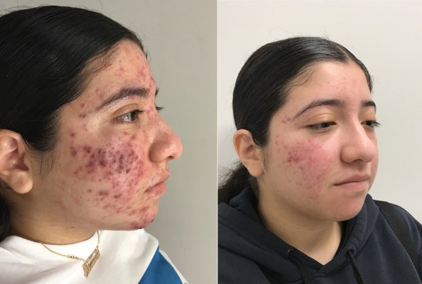 BEFORE AND AFTER - We offer a variety of topical medications, laser treatments, chemical peels, and light therapy to improve acne and acne scars. Treatment regimens are tailored to each individual to deliver personalized results. We specialize in treating acne of all ages with all skin types.
We also offer a variety of treatments for melasma and hyperpigmentation. Lasers available for all skin types including Black and Hispanic skin.
We specialize in cosmetic treatments to provide a more youthful appearance. These include Botox, Filler, and chemical peels. Our unique lasers set us apart and offer natural and youthful skin treatments for skin rejuvenation and skin tightening. BEFORE AND AFTER - We offer a variety of topical medications, laser treatments, chemical peels, and light therapy to improve acne and acne scars. Treatment regimens are tailored to each individual to deliver personalized results. We specialize in treating acne of all ages with all skin types.
We also offer a variety of treatments for melasma and hyperpigmentation. Lasers available for all skin types including Black and Hispanic skin.
We specialize in cosmetic treatments to provide a more youthful appearance. These include Botox, Filler, and chemical peels. Our unique lasers set us apart and offer natural and youthful skin treatments for skin rejuvenation and skin tightening.