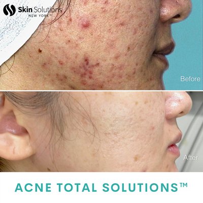 Acne Total Solutions™ - Acne Total Solutions™ is for patients who have severe #acne and #acnescar concerns. 
In order to receive maximum results, Acne Total Solutions™ uses a combination of the following treatments:
✨SkinSol™ Signature Hydrafacial
✨Vbeam 
✨Genius Microneedling RF
