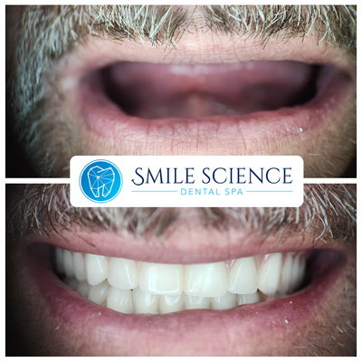 Complete Dentures - This transformative before-and-after picture tells the heartwarming story of a patient who came to Smile Science Dental Spa with unused dentures from a previous dentist. Dissatisfied with the ill-fitting dentures that ended up in a drawer for years, he turned to us in search of a better solution. Over several meticulously planned appointments, Dr. Dawson and Dr. Turke provided him with perfectly fitting dentures, bringing his smile back to life. His radiant grin in the 'after' photo showcases the diligent craftsmanship and patient-centered approach we take at our practice. We are here to ensure every patient can smile with confidence.
