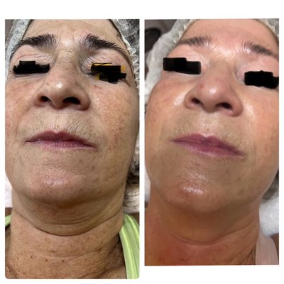 Radio, frequency, micro needling. The best anti-aging collagen producing treatment ever.! - Radio, frequency, micro needling is an incredible technology that send a message to your body to create a rush of collagen and tighten up the skin when you add the radio frequency to it you’re adding energy the penetrates into the dermis to lift in tone and tighten along with the college and rush You can take years off and look amazing! Radio, frequency, micro needling. The best anti-aging collagen producing treatment ever.! - Radio, frequency, micro needling is an incredible technology that send a message to your body to create a rush of collagen and tighten up the skin when you add the radio frequency to it you’re adding energy the penetrates into the dermis to lift in tone and tighten along with the college and rush You can take years off and look amazing!