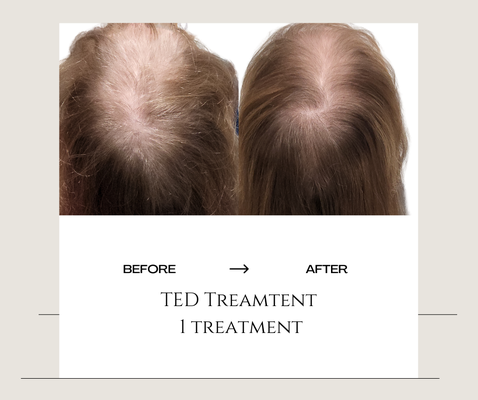 Hair Restoration-TED Treatment - ALMA TED: A revolutionary treatment for thinning hair and hair loss

Alma Ted is a revolutionary, noninvasive treatment of ultrasound-based system that leverages acoustic sound waves to promote improved blood flow to the treatment area and increased penetration of nutrients to the follicle.