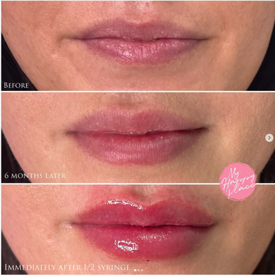 Lips are my favorite area to rejuvenate! - - BEFORE ever having filler
- 6 months AFTER 1 syringe
- IMMEDIATELY after 1/2 syringe
Now that she has 1.5 mLs in her lips, the fullness will last at least one year.
I won’t allow you to overdo it…dysmorphia is a real thing. I’m here for you.
Hydrated lips rejuvenate the whole face immediately. As my kids would say, “it’s so satisfying!” Lips are my favorite area to rejuvenate! - - BEFORE ever having filler
- 6 months AFTER 1 syringe
- IMMEDIATELY after 1/2 syringe
Now that she has 1.5 mLs in her lips, the fullness will last at least one year.
I won’t allow you to overdo it…dysmorphia is a real thing. I’m here for you.
Hydrated lips rejuvenate the whole face immediately. As my kids would say, “it’s so satisfying!”