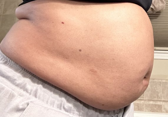 Body Contouring - Abdominal Cavitation - Cavitation is a non-invasive body contouring procedure that employs ultrasound waves to effectively disrupt fat cells. The body naturally eliminates these broken-down cells through the lymphatic system, promoting a slimmer and more sculpted appearance. Body Contouring - Abdominal Cavitation - Cavitation is a non-invasive body contouring procedure that employs ultrasound waves to effectively disrupt fat cells. The body naturally eliminates these broken-down cells through the lymphatic system, promoting a slimmer and more sculpted appearance.