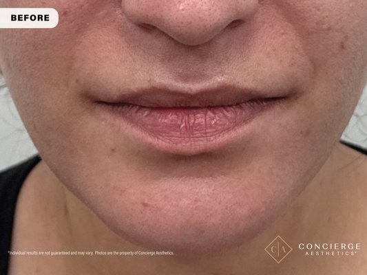 Subtle Lip Flip for Upper Lip Height | Irvine Medspa - This patient wanted to enhance her upper lip—but wasn’t ready for filler.

We performed a lip flip using a small amount of neurotoxin placed along the lip border to gently relax the muscle that pulls the lip inward. This allows the lip to roll outward slightly, creating more visible height without adding volume.

It’s a great option for patients looking for a subtle, natural change or as a first step before considering filler.

Treatment performed by Susie Ergun, PA.