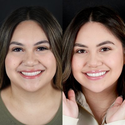 Porcelain Veneers - Porcelain veneers in conjunction with Digital Smile Design was used to rejuvenate this beautiful smile, which was affected by discoloration and tooth wear. Porcelain veneers are a great long term solution to correct cosmetic dislikes and give you a smile you'll love to show off!