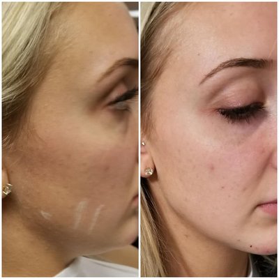 Sculpted Chin & Jawline! - Check out her sculpted Chin & Jawline! This client is thrilled with her results! Sculpted Chin & Jawline! - Check out her sculpted Chin & Jawline! This client is thrilled with her results!
