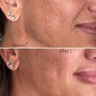 Microneedling treatment $400 - SkinPen before and after spaced only 1 month apart! 🤯

Loving the decrease of hyperpigmentation, smoothing of texture, and increase in overall “bounciness” of the skin. 👶🏼
This was the patient’s 4th Skinpen treatment with me and she’s loving her results!👏🏼