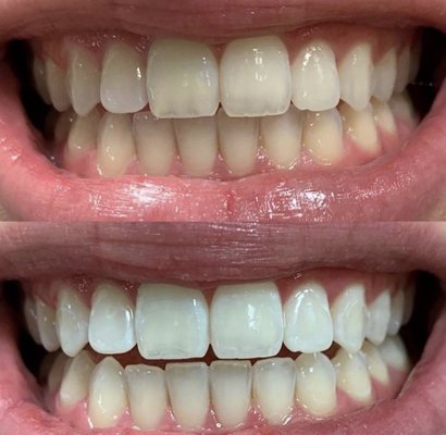Teeth whitening - Come in and get a whiter smile in just 1 hit with LED teeth whitening Teeth whitening - Come in and get a whiter smile in just 1 hit with LED teeth whitening