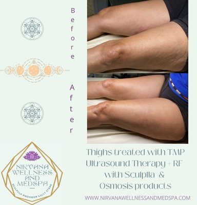 Ultrasound therapy + RF body treatments - Body treatments with a combination of modalities.
Reduce wrinkles, crepey skin, cellulite, can reduce small spider veins, and hyperpigmentation. Ultrasound therapy + RF body treatments - Body treatments with a combination of modalities.
Reduce wrinkles, crepey skin, cellulite, can reduce small spider veins, and hyperpigmentation.