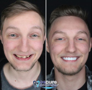 A new smile, a new you! - Our experienced team understands the importance of a natural look and comfortable fit. Whether you're missing one tooth or need a full-mouth restoration, we provide personalized solutions tailored to your unique needs. From single tooth implants to implant supported dentures and traditional dentures, we use advanced technology and high quality materials to ensure lasting results. A new smile, a new you! - Our experienced team understands the importance of a natural look and comfortable fit. Whether you're missing one tooth or need a full-mouth restoration, we provide personalized solutions tailored to your unique needs. From single tooth implants to implant supported dentures and traditional dentures, we use advanced technology and high quality materials to ensure lasting results.