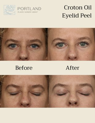 Luxe Eyelid Peel - The Eyelid Luxe Peel is a powerful, croton oil-based chemical peel designed to tackle deep wrinkles, sun damage, and stubborn skin concerns that just don’t budge with other peels or lasers.