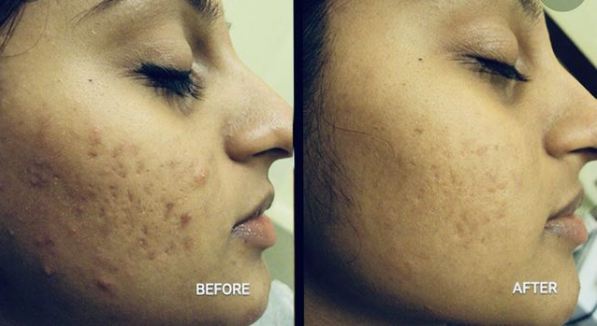 Advanced Peel for Acne - Lana’s Advanced Acne Peel! Corrects Sun Damage, Acne Scarring & Uneven Skin tone. Lana’s beauty Zone Advanced Peel Series, Reduces fine lines and wrinkles, acne scarring and helps stimulate collagen and elastin production! This service is available for both oily and combination skin. Advanced Peel for Acne - Lana’s Advanced Acne Peel! Corrects Sun Damage, Acne Scarring & Uneven Skin tone. Lana’s beauty Zone Advanced Peel Series, Reduces fine lines and wrinkles, acne scarring and helps stimulate collagen and elastin production! This service is available for both oily and combination skin.