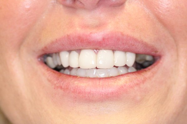 New Smile - S. was missing a few teeth. We did a dental bridge to fill in the space. New Smile - S. was missing a few teeth. We did a dental bridge to fill in the space.