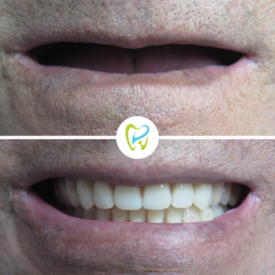 Dental Implants & Crowns Before/After Transformations! - Take a look at a variety of dental implant, crown, extraction and veneer before and afters we have completed! Please contact us to schedule a complimentary consultation. (310) 953-3661 https://www.dentistcarson.com/ Dental Implants & Crowns Before/After Transformations! - Take a look at a variety of dental implant, crown, extraction and veneer before and afters we have completed! Please contact us to schedule a complimentary consultation. (310) 953-3661 https://www.dentistcarson.com/
