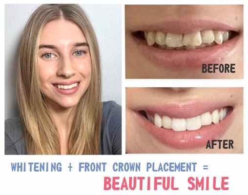 Before & After - This patient was not happy because one of the teeth changed the color due to the trauma, our office performed Teeth Whitening first and then placed crown for the front tooth to match the color. At the end we have got an amazing smile! Patient was very happy with a results.