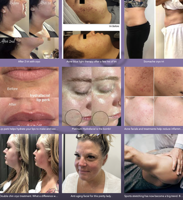 Before & After Portfolio - • Helping you achieve your best skin goals with Hydrafacials
• Cryotherapy pain relief
• Licensed Esthetician 10+ years

Learn more about all of our services including facials, dermaplaning, massages, chemical peels, body scrubs, cryotherapy and more!