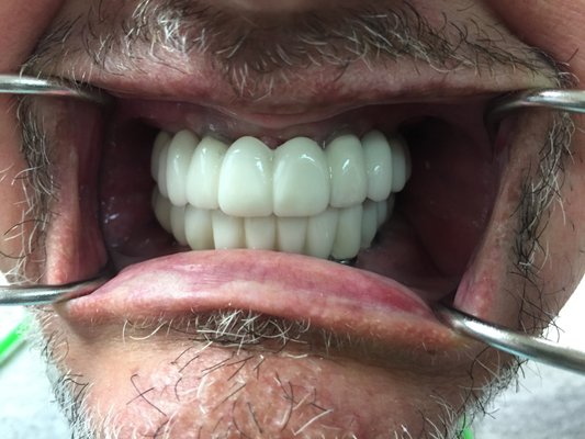 Implant supported dentures - This patient had all teeth removed, 8 implants placed and a final permanent bridge to sit on the implants.