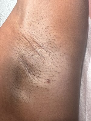 Sugaring Wax - The best result Sugaring Wax - The best result